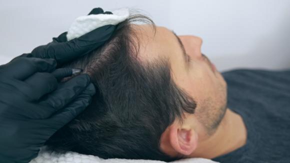 Tricopigmentation  cheveux