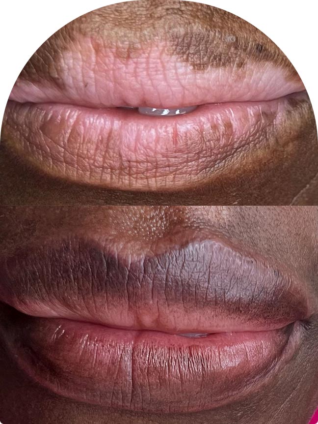 Dermopigmentation réparatrice